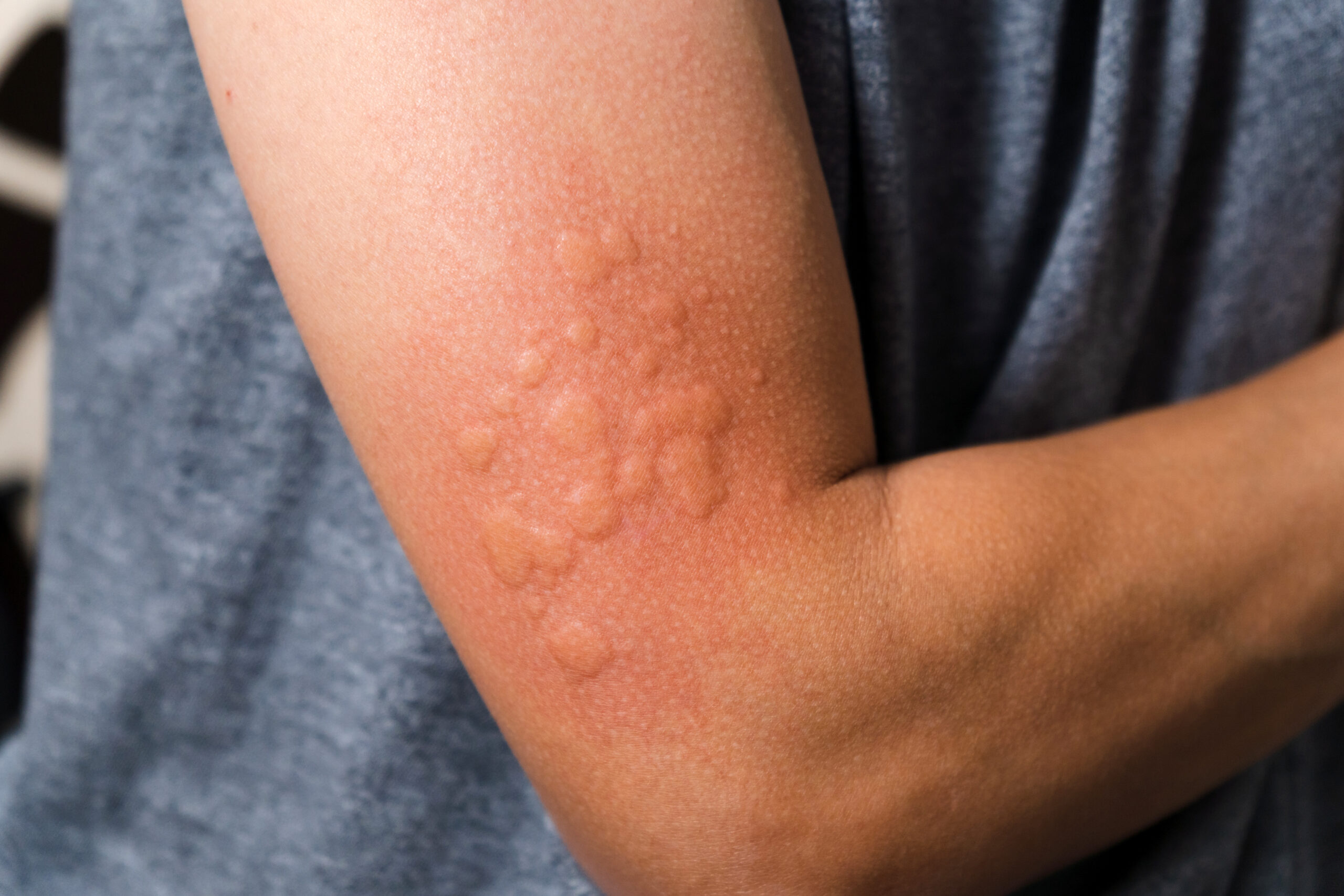 Understanding Latex Allergies and Safer Alternatives Balloon Safety: Ensuring a Fun and Safe Celebration